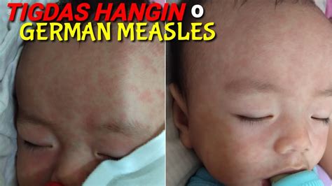 Measles Tigdas Hangin O German Measles Ito Ang Dumapo Sa Anak Ko