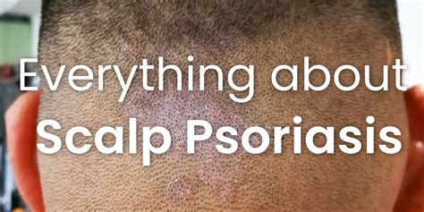 Everything About Scalp Psoriasis Gen C Beauty