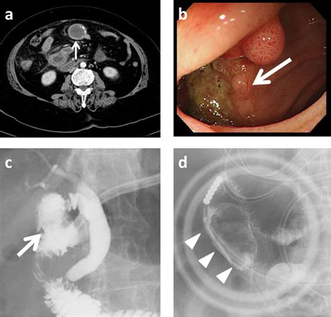 Figure 1 From Single Incision Laparoscopic Surgery For Gallstone Ileus