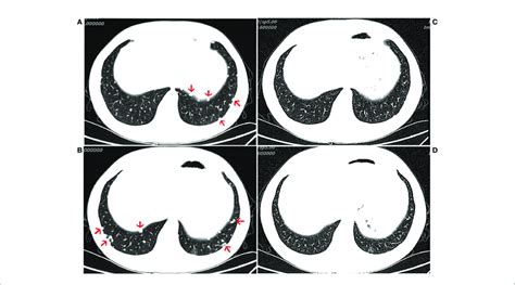 Computed Tomography Ct Of The Chest Ct Scans Showing The Chest A