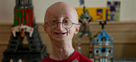 Knowing Progeria An Aging Disease Caused By Gene Mutation Healthy Panacea