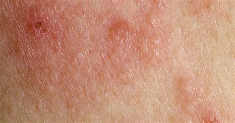 Causes Of Itchy Skin Rash Livestrongcom