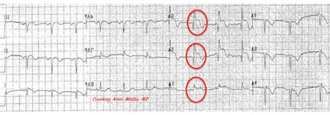 Posterior Myocardial Infarction How Accurate Is The Flipped Ecg Trick