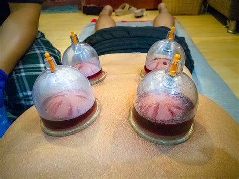 The Potential Pain Relieving Effects Of Wet Cupping Therapy