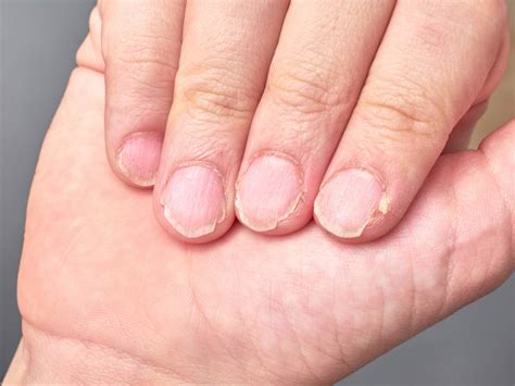 Br Chige Fingern Gel Ursachen Und Behandlung Fernarzt