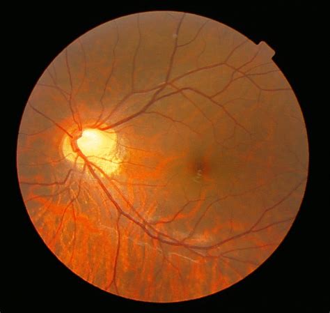 Fundus Of A Patient With Congenital Stationary Night Blindness