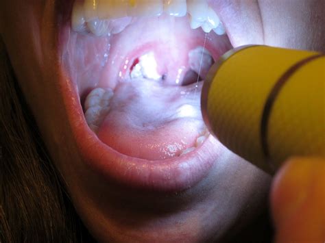 If they don't naturally dislocate and either gargle with salt water or use a water flosser to rinse bacteria off of your tonsils every week. Now this is podracing!: Ever had your tonsils out?