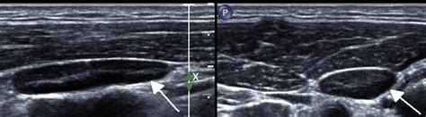 Ultrasonography Of Cervical Lymph Nodes Radiologic Clinics