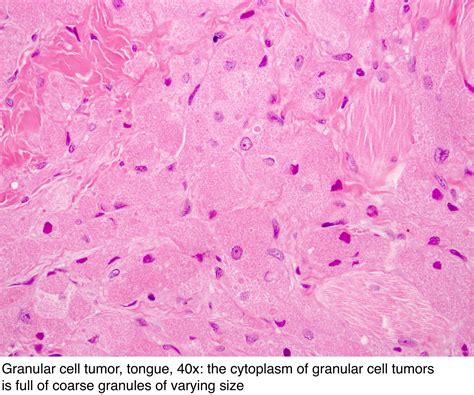 Pathology Outlines Granular Cell Tumor