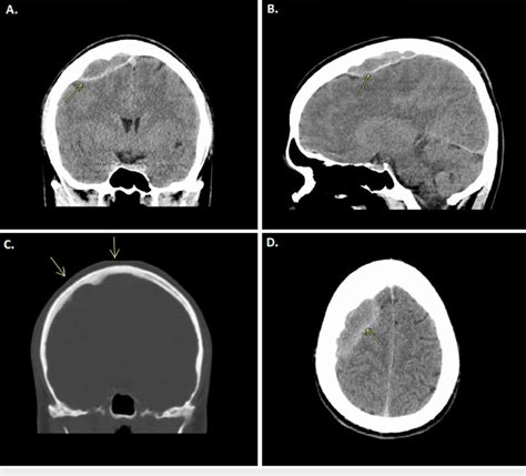 Ct Scan Without Contrast Of The Brain In Coronal Sagittal And Axial