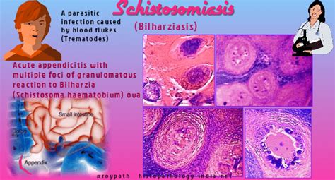 Pathology Of Schistosomiasis Dr Sampurna Roy Md