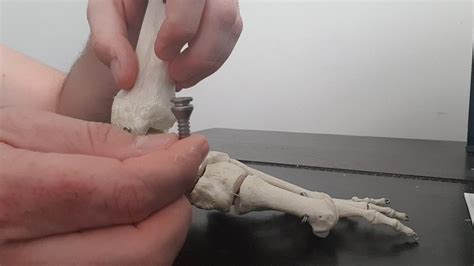 Using The Hyprocure Implant To Correct Flexible Flatfoot Youtube