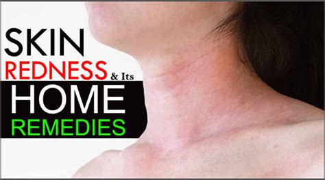 Skin Redness And Its Home Remedies