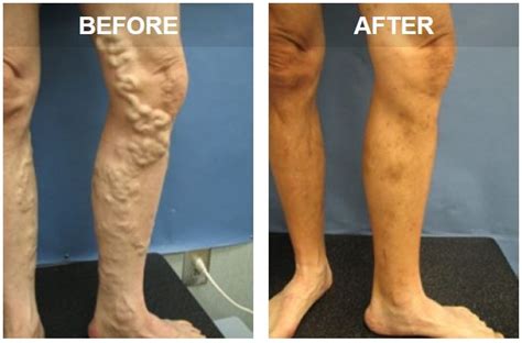 Let your arms hang down. How To Get Veins To Pop In Arms