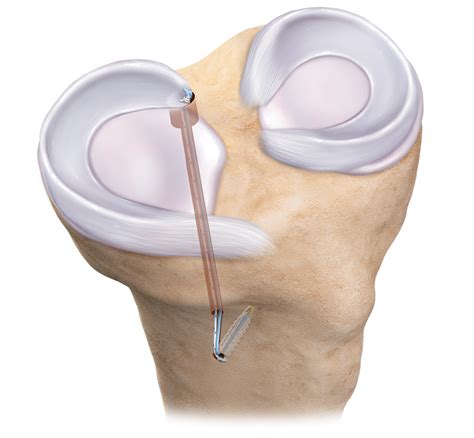 Arthrex Meniscal Root Repair