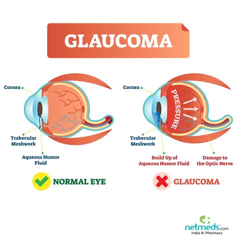 It's usually caused by fluid building up in the front part of the eye, which increases pressure. Glaucoma: Causes, Symptoms And Treatment | Netmeds