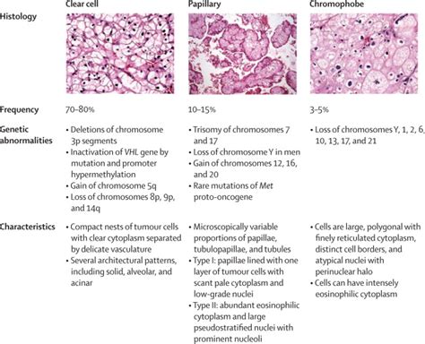 Renal Cell Carcinoma The Lancet