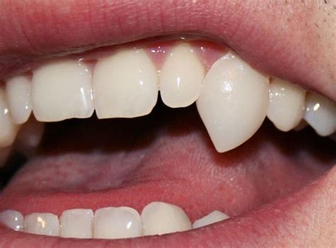Teeth Normal Teeth With Extra Large Canines Teeth Aesthetic Teeth