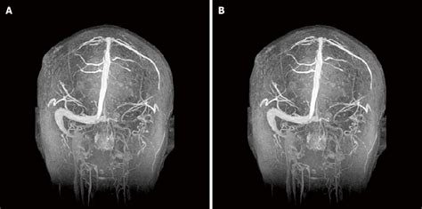 Hypereosinophilia With Cerebral Venous Sinus Thrombosis And Intracerebral Hemorrhage A Case