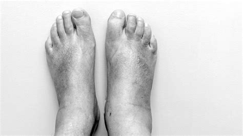 Heart Failure And Swollen Feet Link Treatment And More