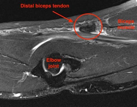 Distal Biceps Tendon Rupture The Bone School