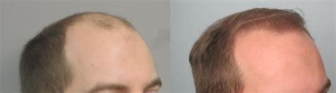 Fut Hair Transplant On Year Old Male Hair Restoration Of The South