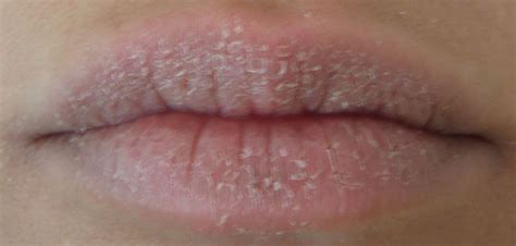 Reduce Peeling At Peeling Lips Exfoliative Cheilitis With Image