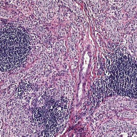 Lymphoid Follicular Hyperplasia In The Mucosa Above The Tumor