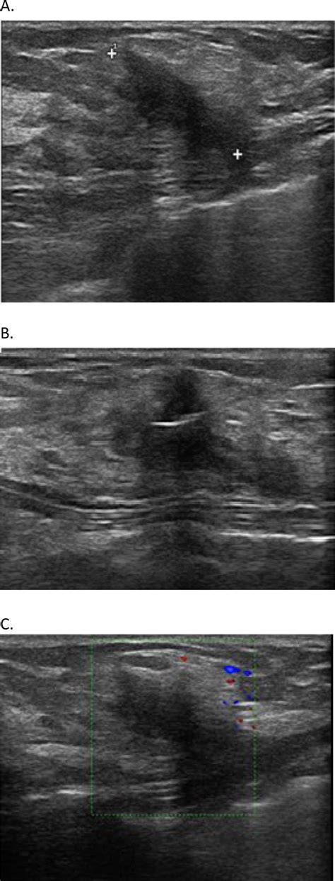 Left Breast Ultrasound Shown A A Hypoechoic Coarse Distortion With