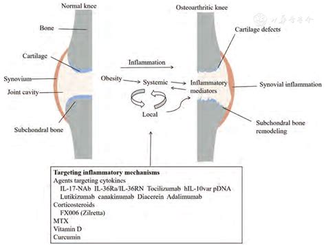 Inflammatory Phenotype Of Osteoarthritis And Its Potential Therapies