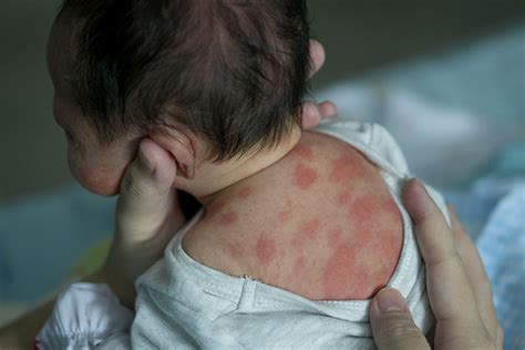 22 Different Causes Of Rashes In Babies And Their Prevention