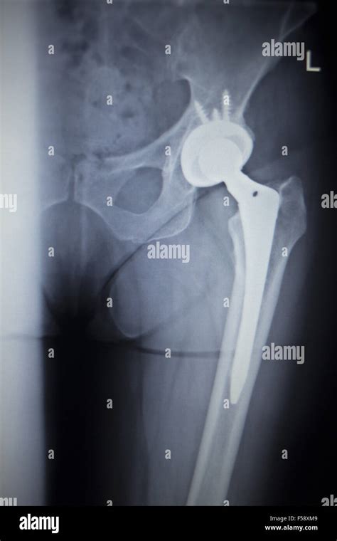 X Ray Scan Image Of Hip Joints With Orthopedic Hip Joint Replacement