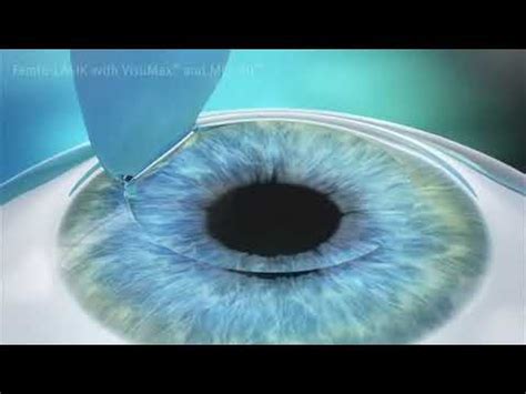 FEMTO LASIK Bladeless Laser Eye Surgery ZEISS YouTube