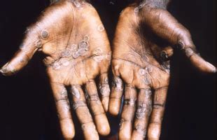 Currently, there are 3 antiviral compounds. WHO | Human Monkeypox (MPX)