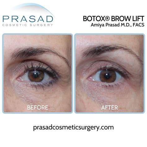 Brow Lift Before And After Photos Manhattan And Long Island Ny