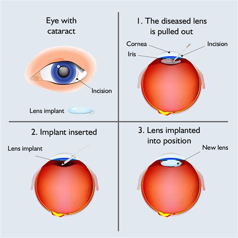 Cataract Surgery H Medical