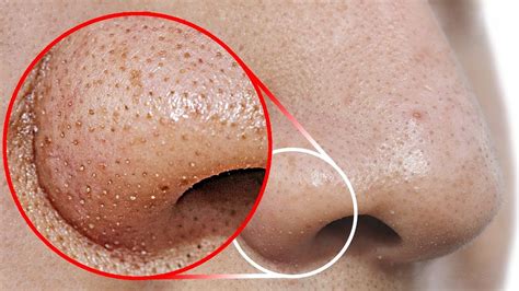 Do This To Remove Blackheads From Your Nose Youtube