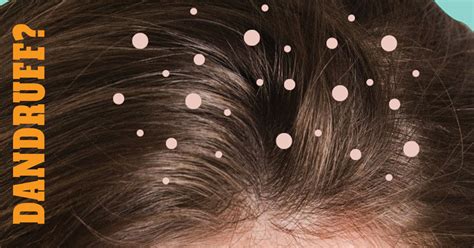 Dandruff Causes And Treatment