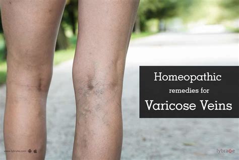 Homeopathy Treatment For Varicose Veins In Legs Review Home Co