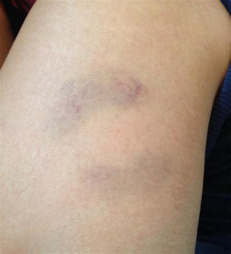 List 100 Images Pictures Of Bruises On Arms Superb