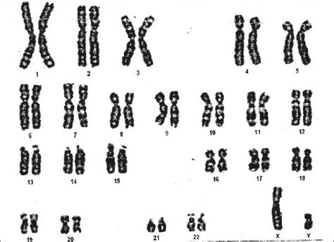 Karyotype Of The Patient Normal Autosomes And Abnormal Sex Download Scientific Diagram