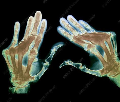 Arthritic Hands X Ray Stock Image M1100688 Science Photo Library