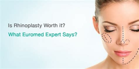 When you visit our free nyc outpatient. Is There Any Risk-Free Rhinoplasty Procedure? Is it Worth ...