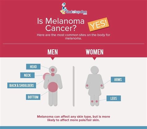Melanoma Symptoms Causes Treatment And Diagnosis Findatopdoc
