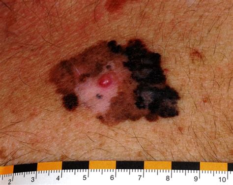 A Nodular Melanoma Nm That Developed Secondarily Within A Superficial