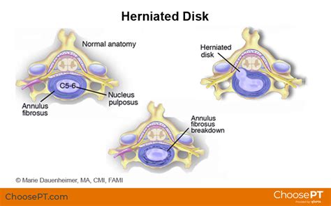 Guide Physical Therapy Guide To Herniated Disk Choose Pt