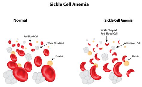 The defect forms abnormal hemoglobin. What Your Yellowish Skin Tone is Telling You - Healevate