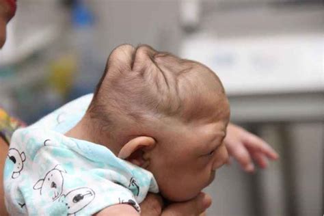 Após Nascimento Bebês Com Zika Desenvolvem Microcefalia Diz Estudo