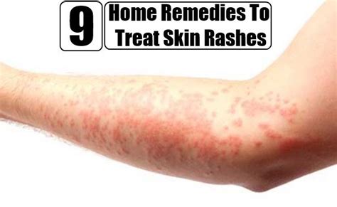 Ayurvedic Treatment For Skin Rashes And Itching Arnetteroegner 99