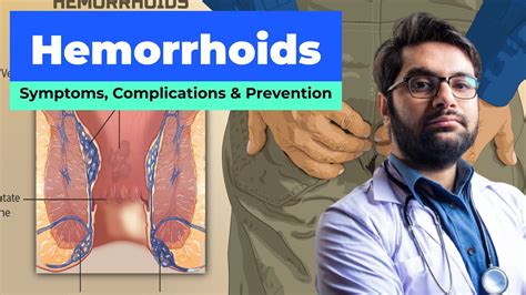 Hemorrhoids Symptoms Complications Prevention Medical Health Explainer Youtube